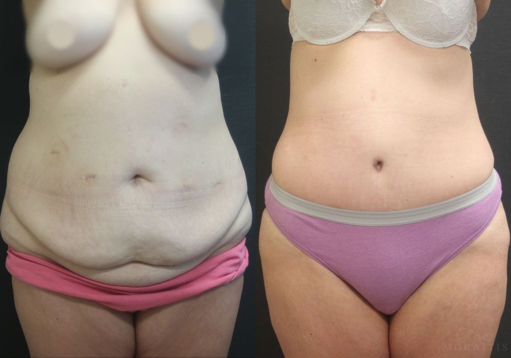 Tummy Tuck - Case 15352