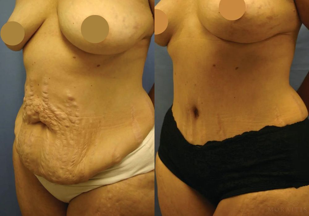 Tummy Tuck - Thumbnail 2