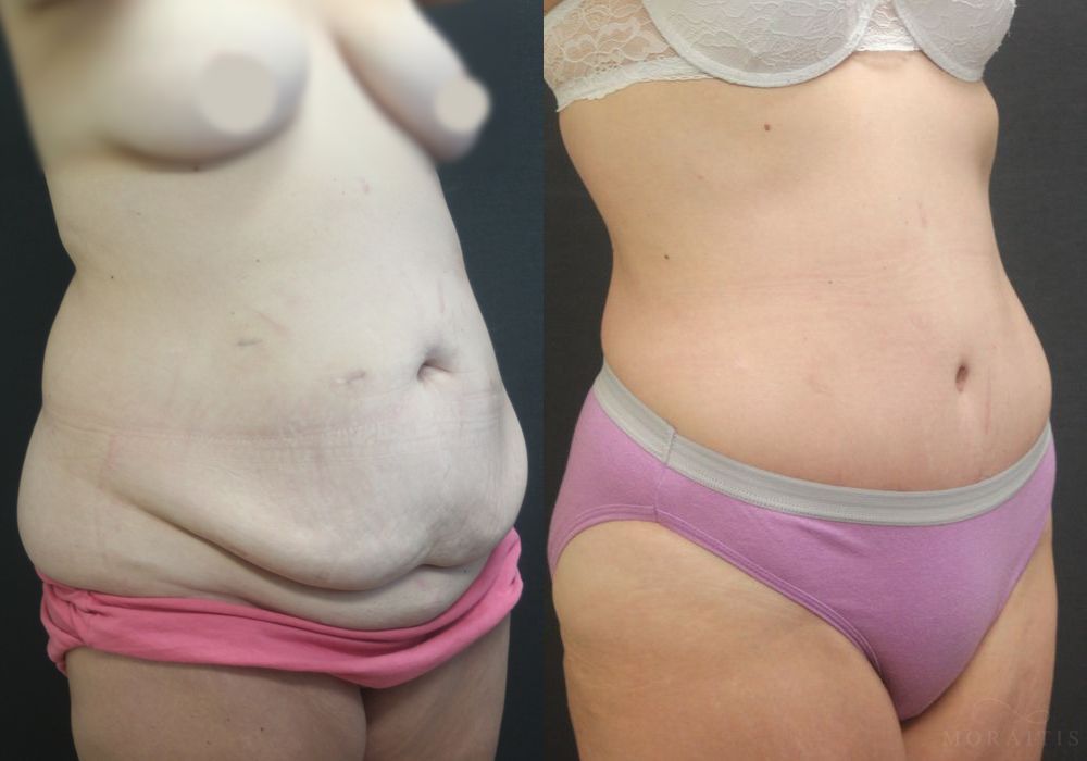 Tummy Tuck - Thumbnail 2