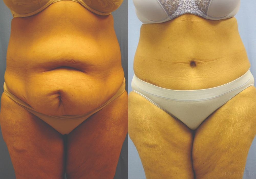 Tummy Tuck - Case 15358