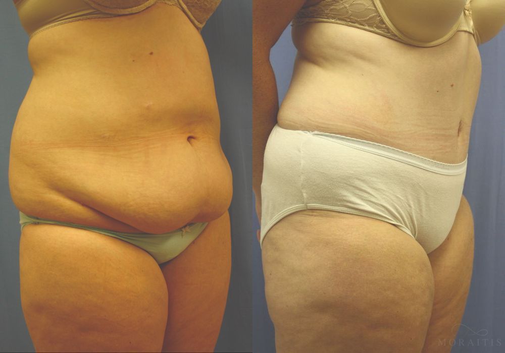 Tummy Tuck - Thumbnail 2