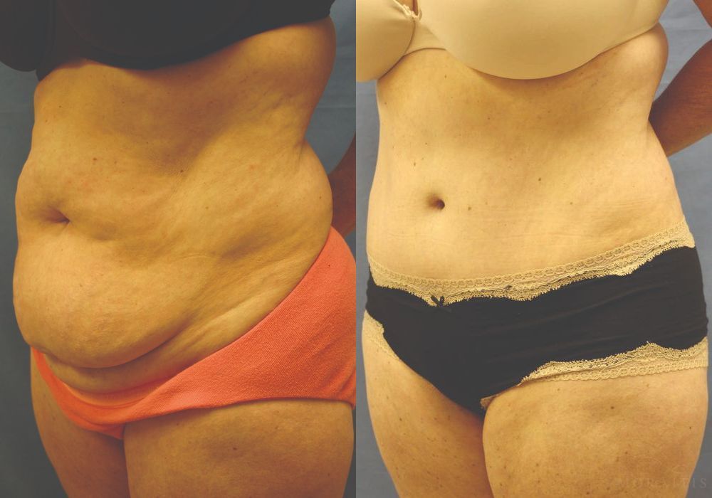 Tummy Tuck - Thumbnail 2