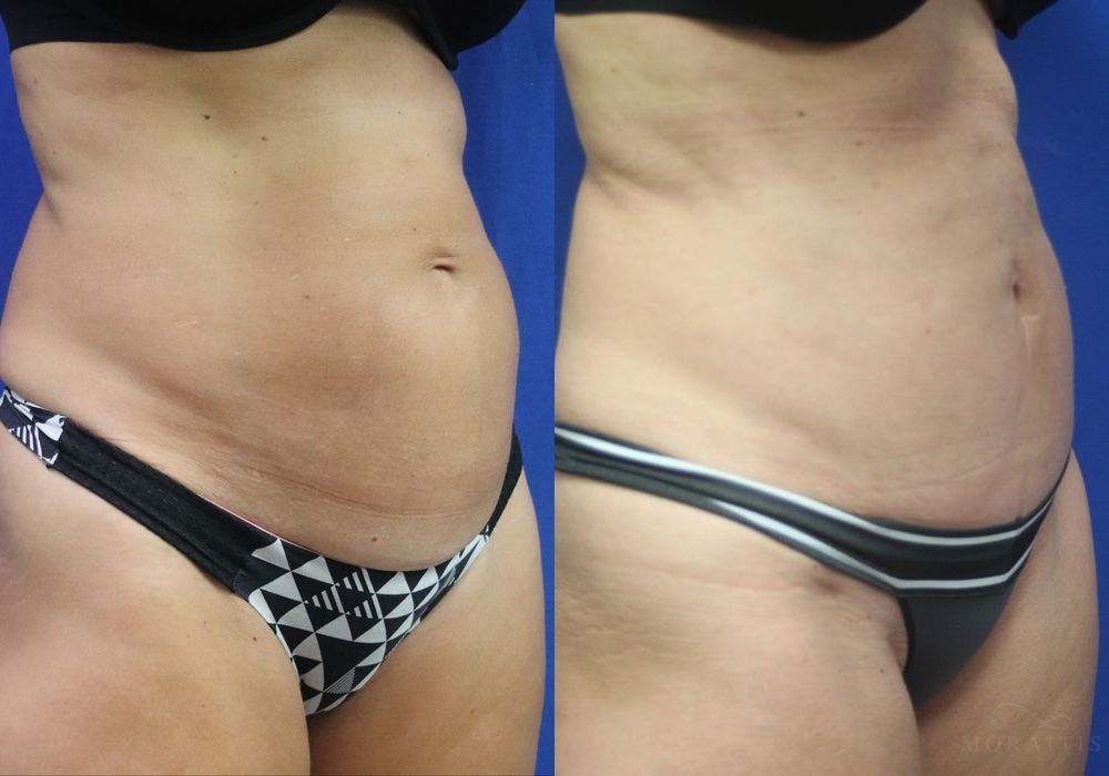 Tummy Tuck - Thumbnail 2