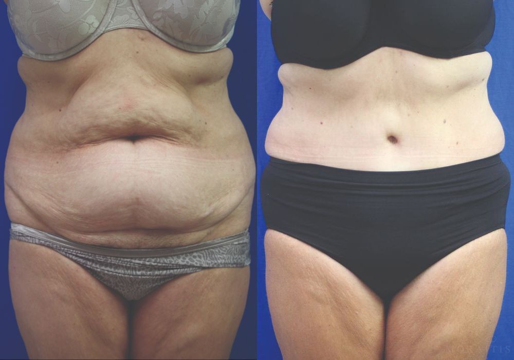 Tummy Tuck - Case 15357