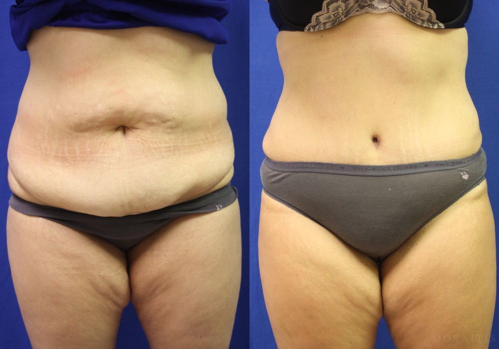 Tummy Tuck - Case 15348