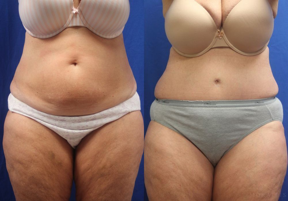 Tummy Tuck - Case 15347