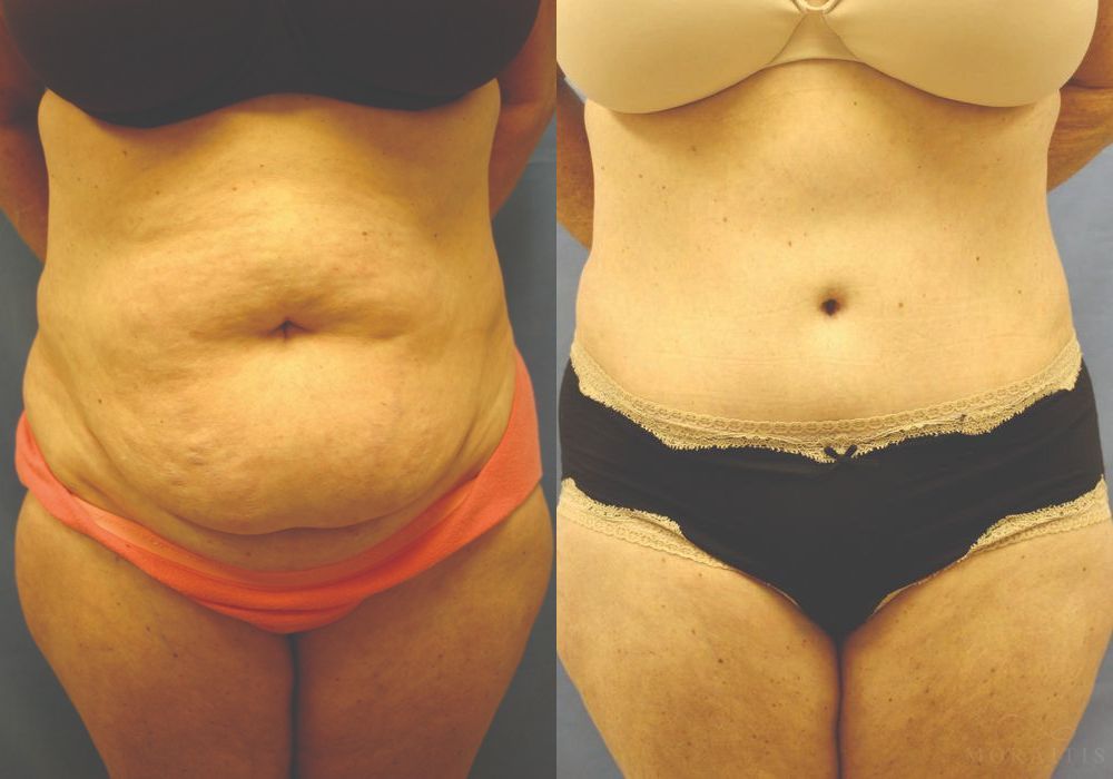 Tummy Tuck - Case 15356