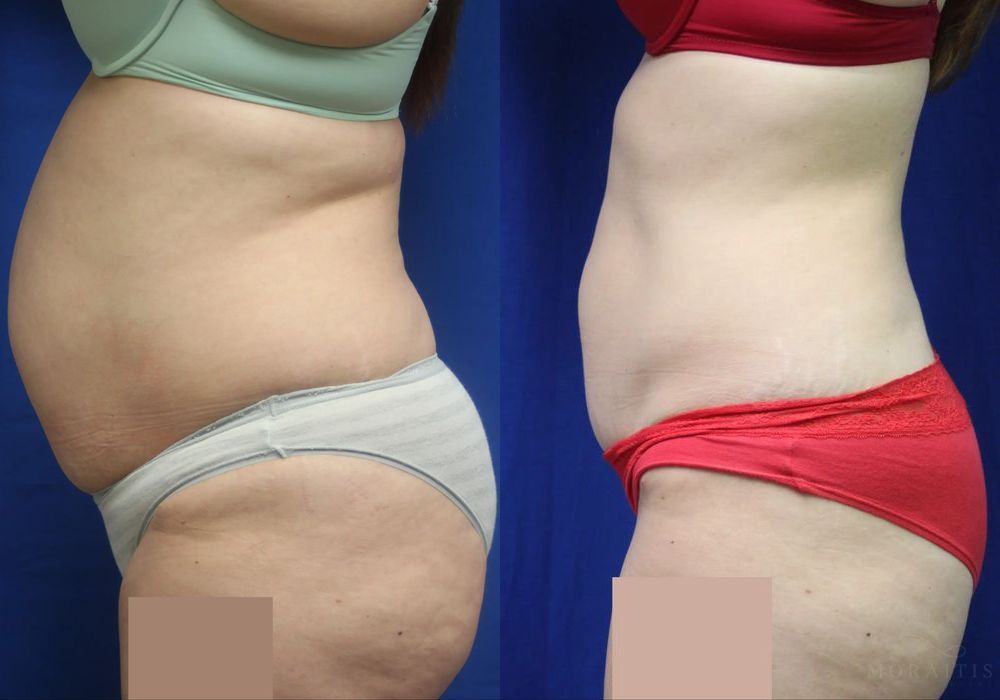 Tummy Tuck - Thumbnail 3