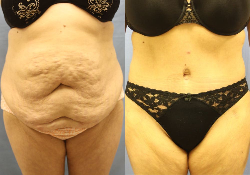 Tummy Tuck - Case 15342