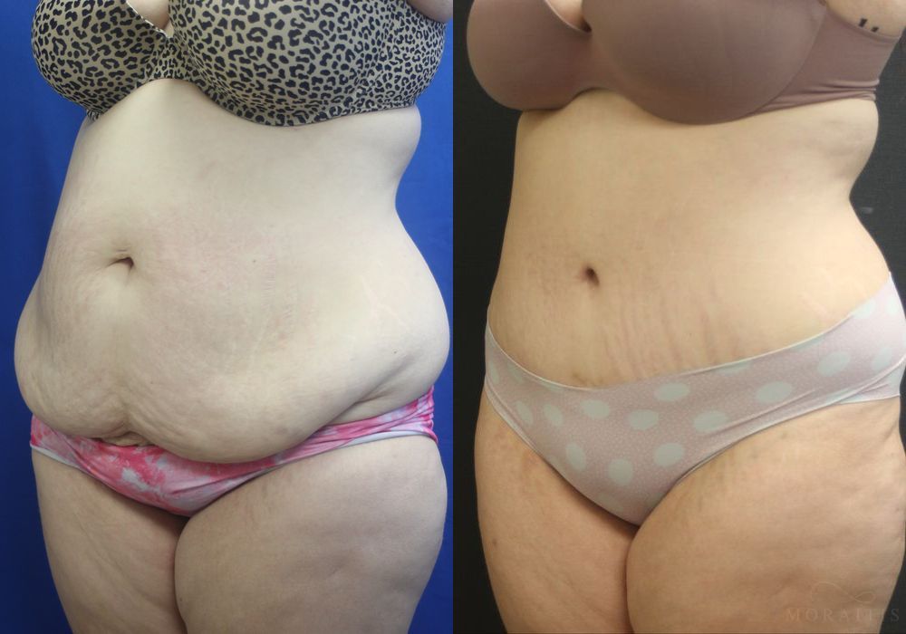 Tummy Tuck - Thumbnail 2