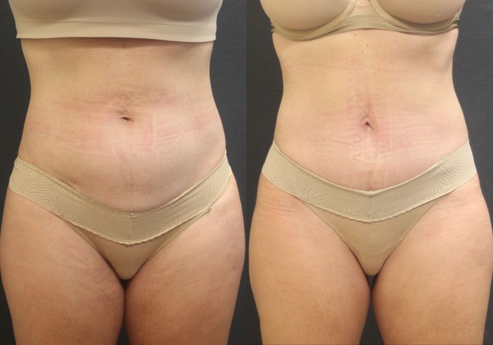 Tummy Tuck - Case 15364