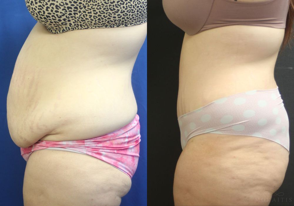 Tummy Tuck - Thumbnail 3