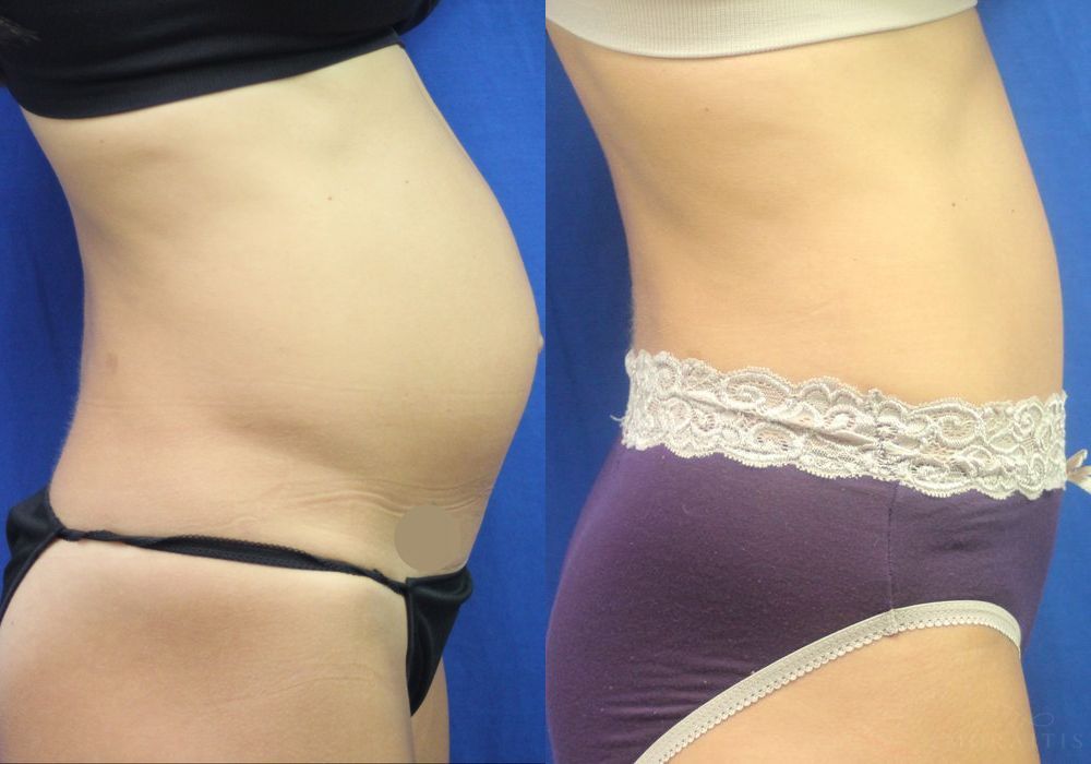 Tummy Tuck - Thumbnail 2