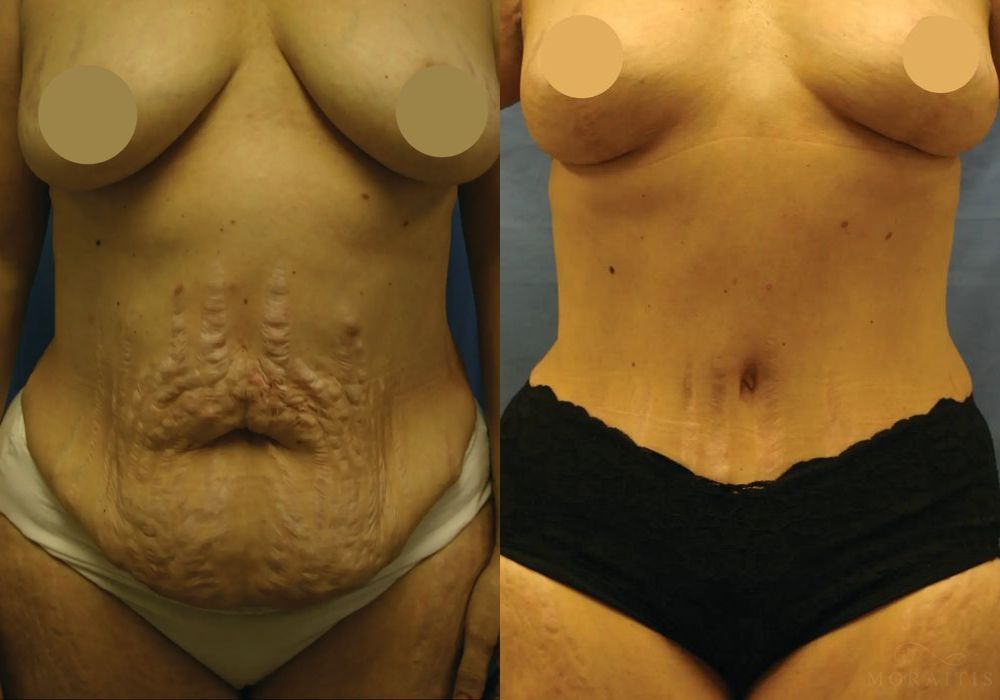 Tummy Tuck - Case 15353