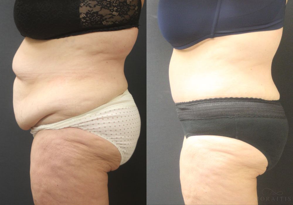 Tummy Tuck - Thumbnail 3