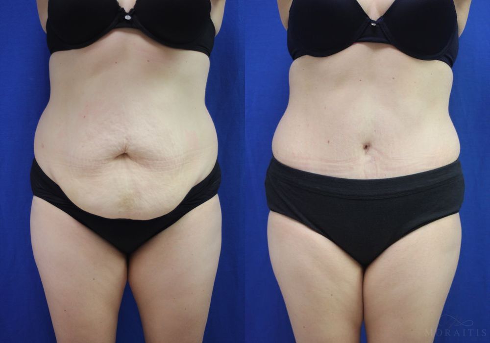 Tummy Tuck - Case 15346
