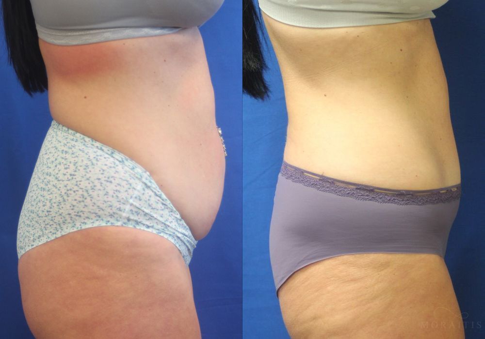 Tummy Tuck - Thumbnail 3