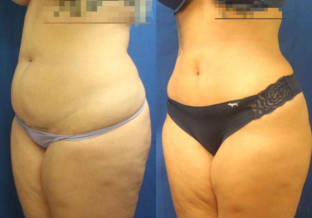 Tummy Tuck -Mini - Thumbnail 2