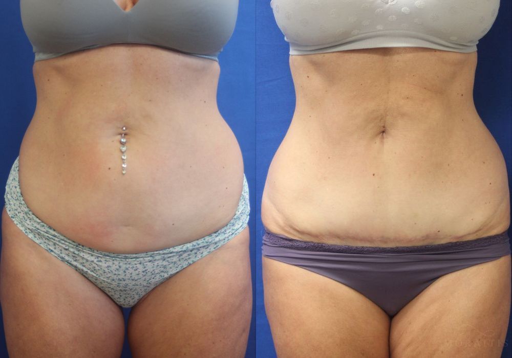 Before and after procedure result