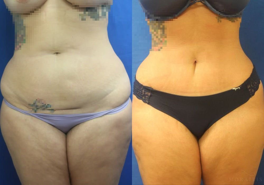 Tummy Tuck -Mini - Case 15515