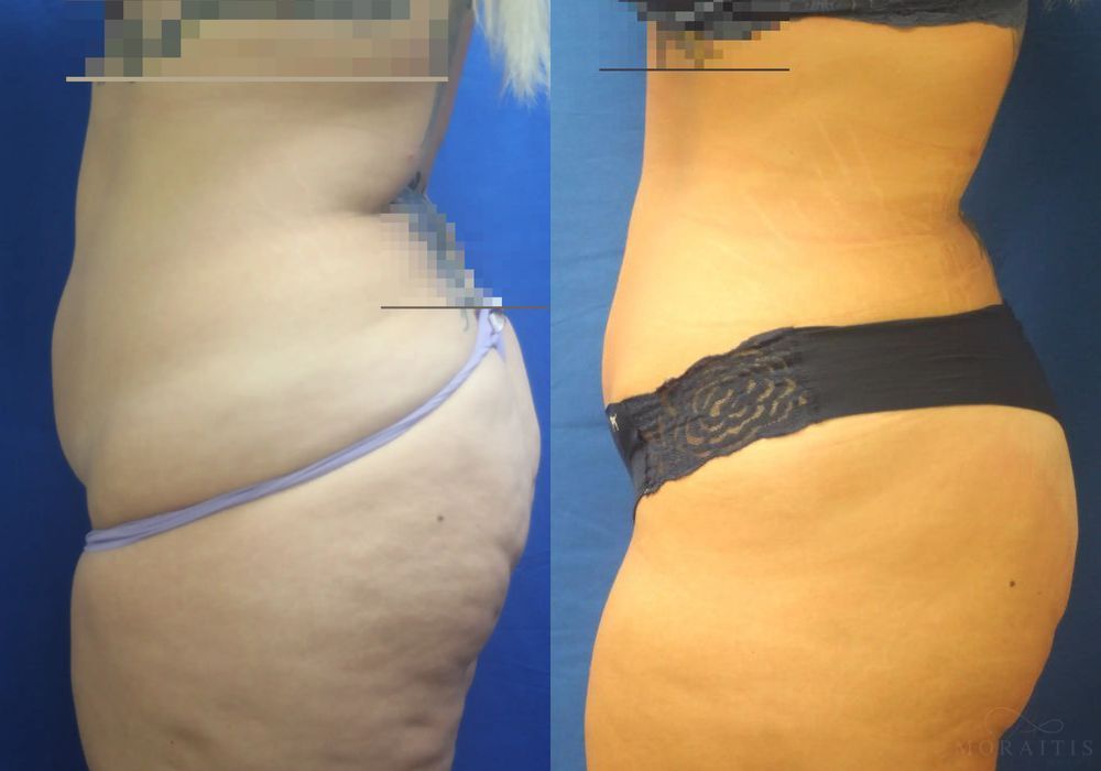 Tummy Tuck -Mini - Thumbnail 3