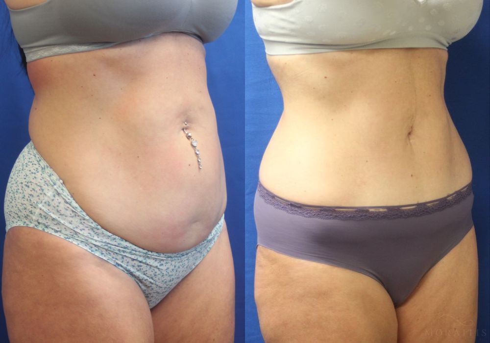 Tummy Tuck - Thumbnail 2