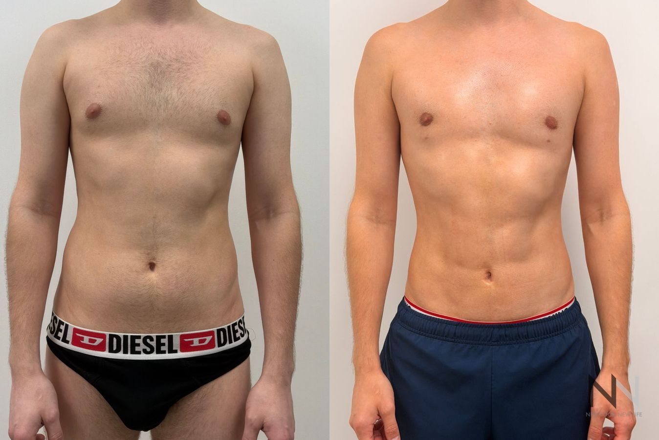 Before-and-after photos of male abdominal etching by Dr. Claudia Kim, showcasing high-definition liposuction that creates a defined, athletic abdominal appearance.