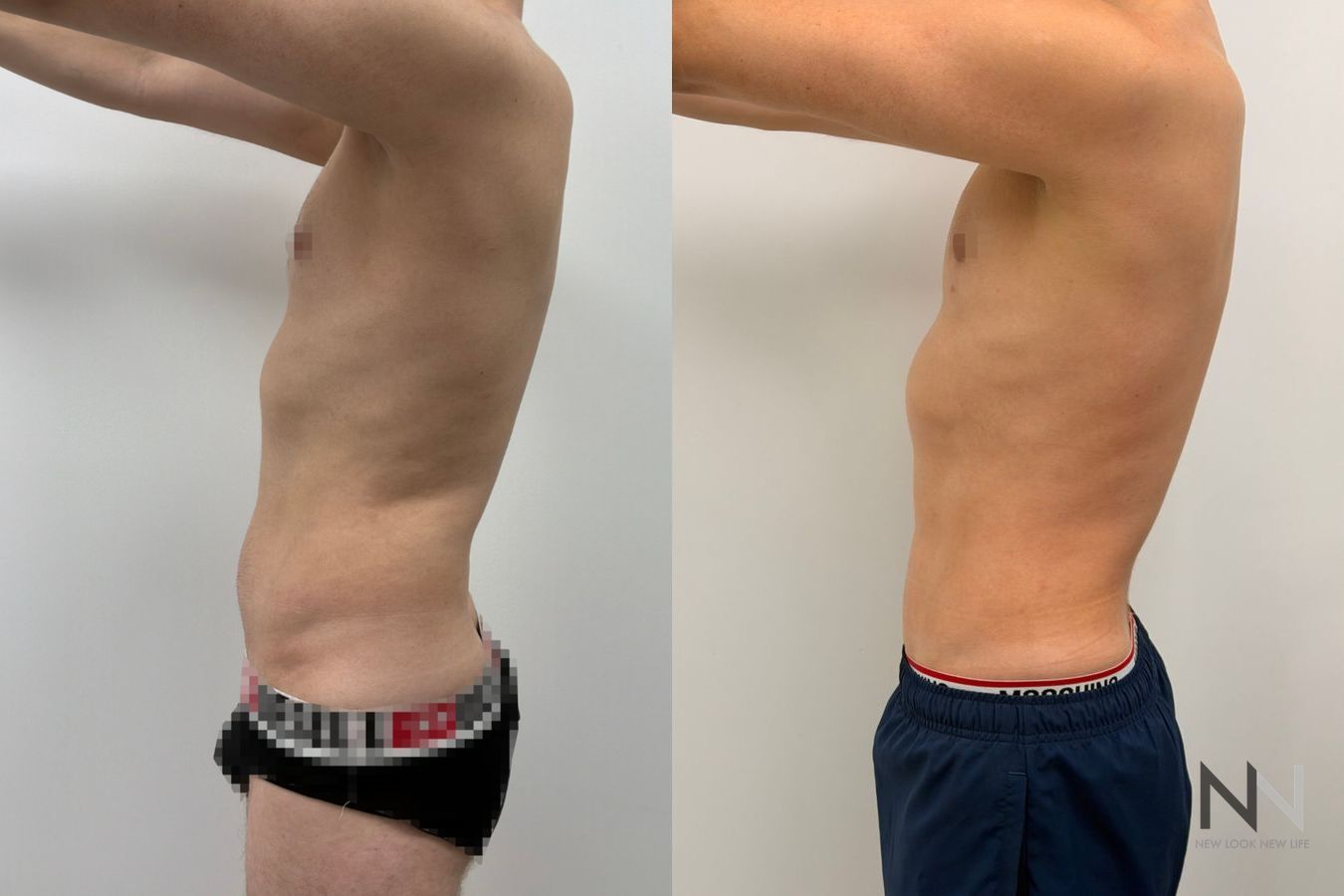 Before-and-after images of male liposuction by Dr. Claudia Kim, featuring body contouring of the abdomen, flanks, chest, and lower back for a more sculpted masculine physique. - Angle 6