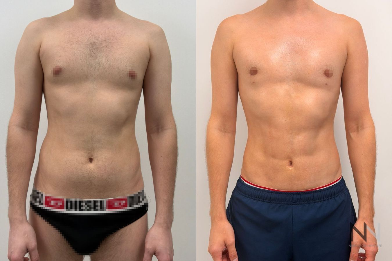 Before-and-after images of male liposuction by Dr. Claudia Kim, featuring body contouring of the abdomen, flanks, chest, and lower back for a more sculpted masculine physique.
