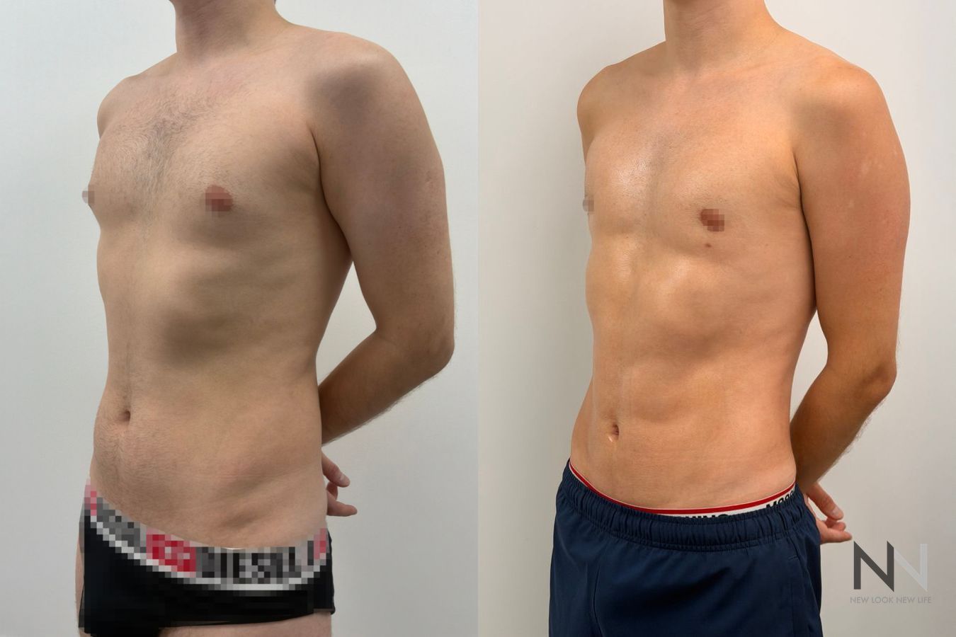 Before-and-after images of male liposuction by Dr. Claudia Kim, featuring body contouring of the abdomen, flanks, chest, and lower back for a more sculpted masculine physique. - Angle 5