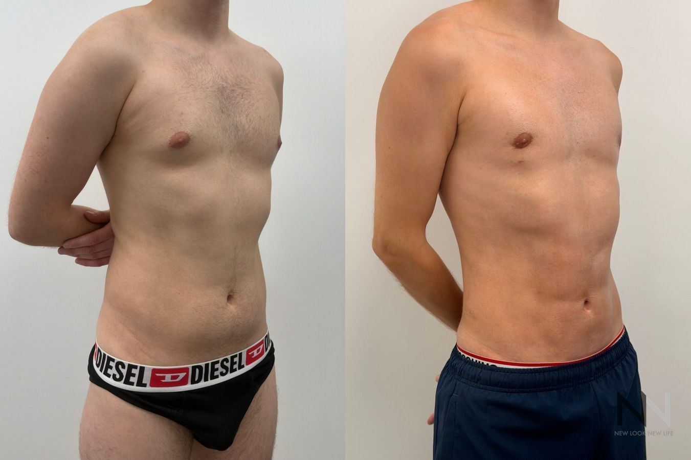 Before-and-after photos of male abdominal etching by Dr. Claudia Kim, showcasing high-definition liposuction that creates a defined, athletic abdominal appearance. - Angle 3