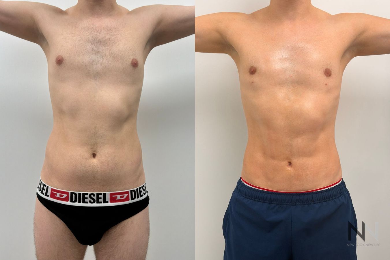 Before-and-after photos of male abdominal etching by Dr. Claudia Kim, showcasing high-definition liposuction that creates a defined, athletic abdominal appearance. - Angle 2