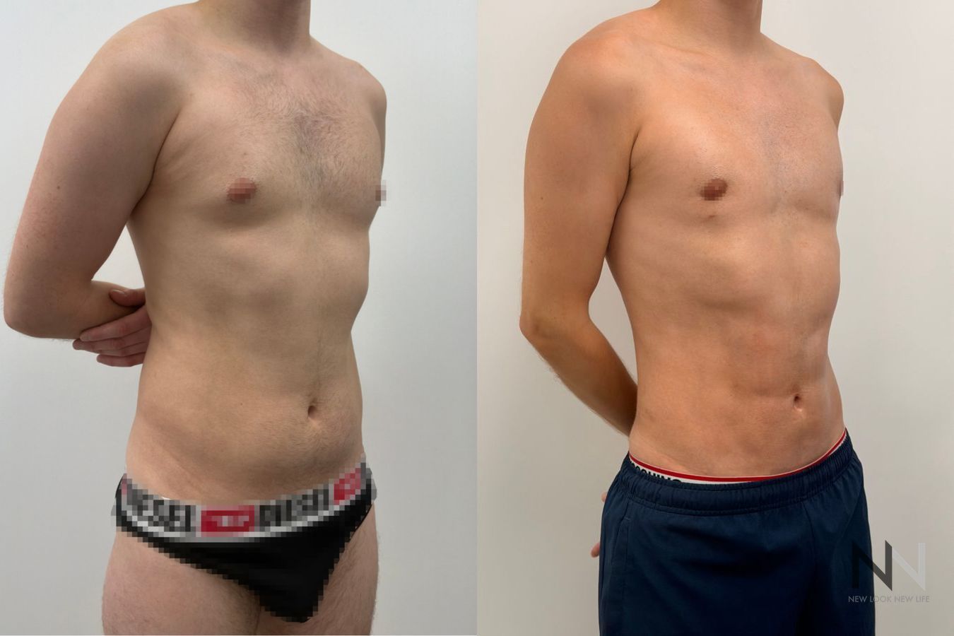 Before-and-after images of male liposuction by Dr. Claudia Kim, featuring body contouring of the abdomen, flanks, chest, and lower back for a more sculpted masculine physique. - Angle 3