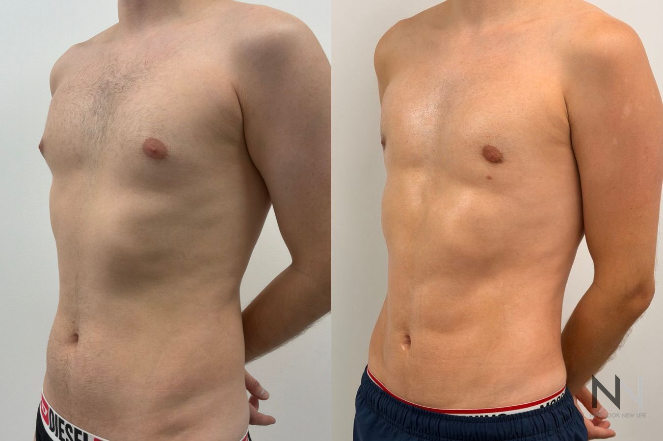 Before-and-after photos of male abdominal etching by Dr. Claudia Kim, showcasing high-definition liposuction that creates a defined, athletic abdominal appearance. - Angle 5