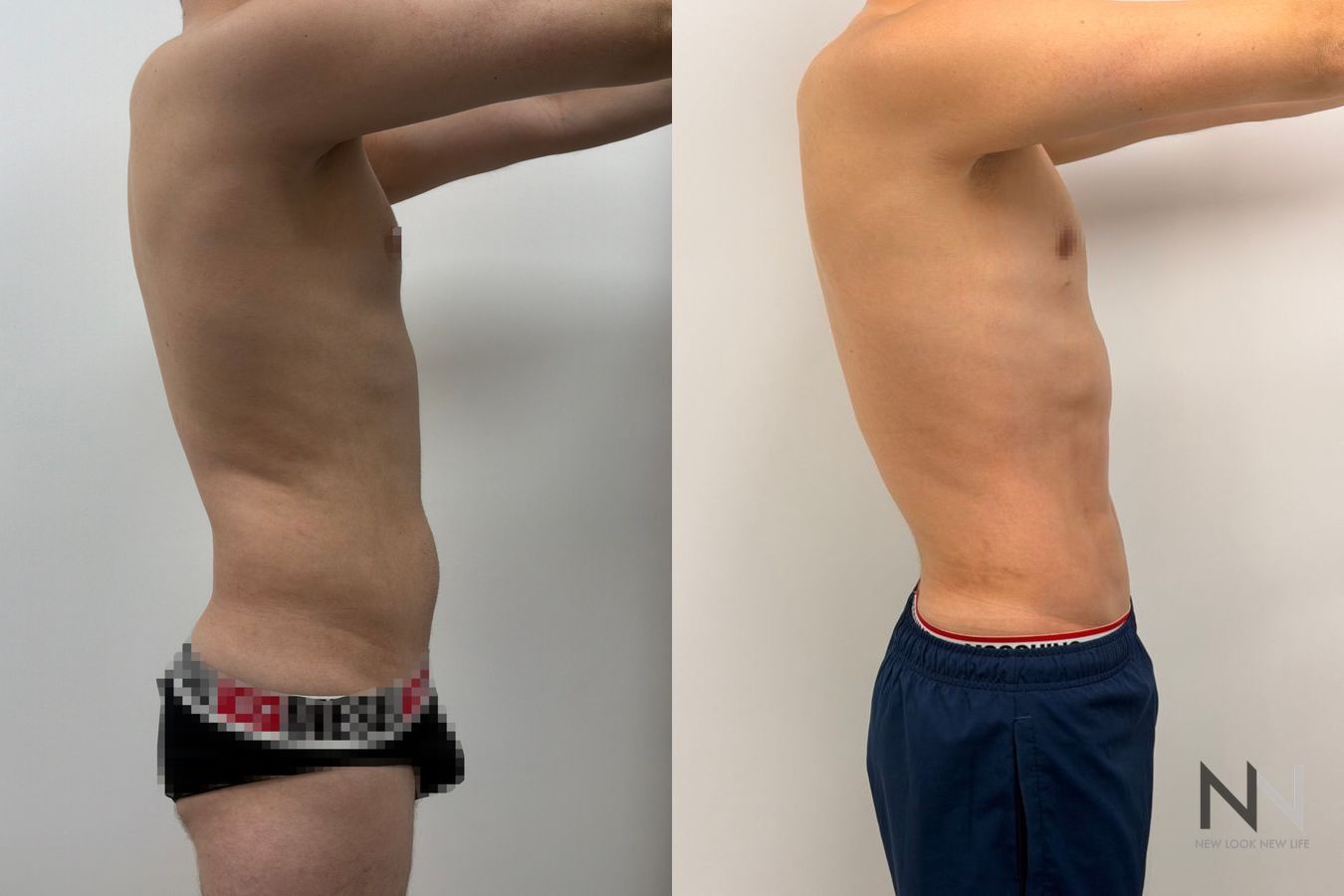 Before-and-after images of male liposuction by Dr. Claudia Kim, featuring body contouring of the abdomen, flanks, chest, and lower back for a more sculpted masculine physique. - Angle 4