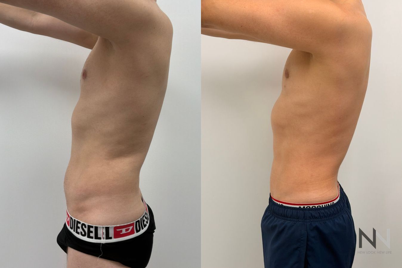 Before-and-after photos of male abdominal etching by Dr. Claudia Kim, showcasing high-definition liposuction that creates a defined, athletic abdominal appearance. - Angle 6