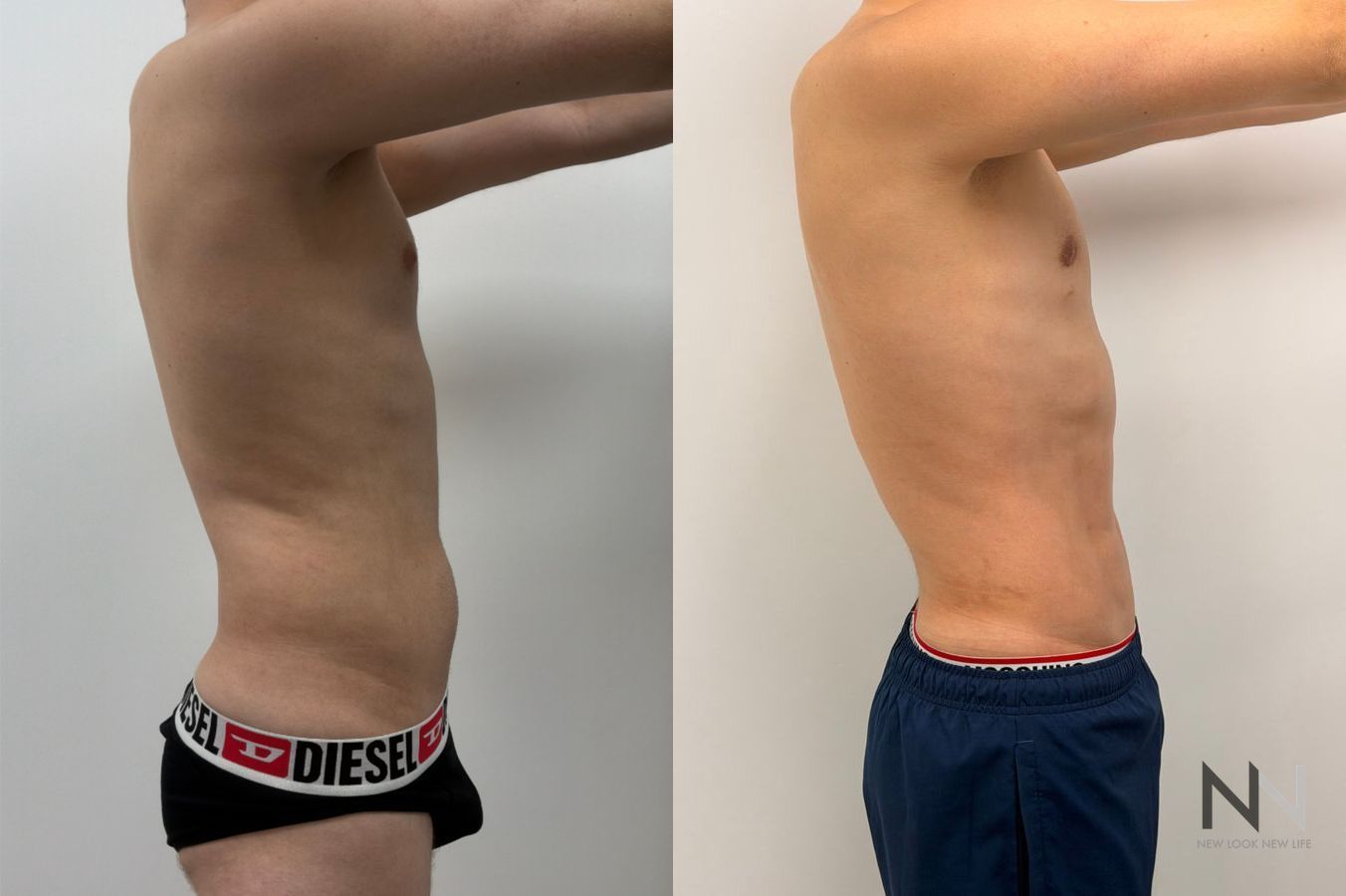 Before-and-after photos of male abdominal etching by Dr. Claudia Kim, showcasing high-definition liposuction that creates a defined, athletic abdominal appearance. - Angle 4