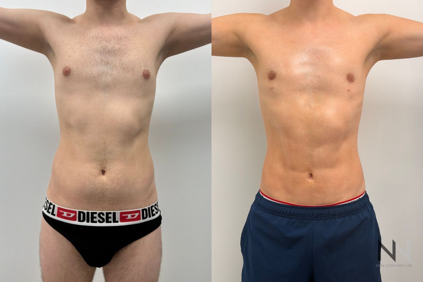 Before-and-after images of male liposuction by Dr. Claudia Kim, featuring body contouring of the abdomen, flanks, chest, and lower back for a more sculpted masculine physique. - Angle 2
