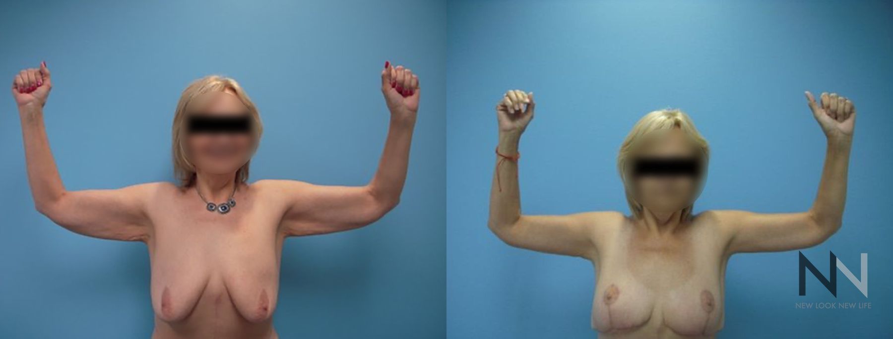 Before and after arm lift and breast lift six months results
