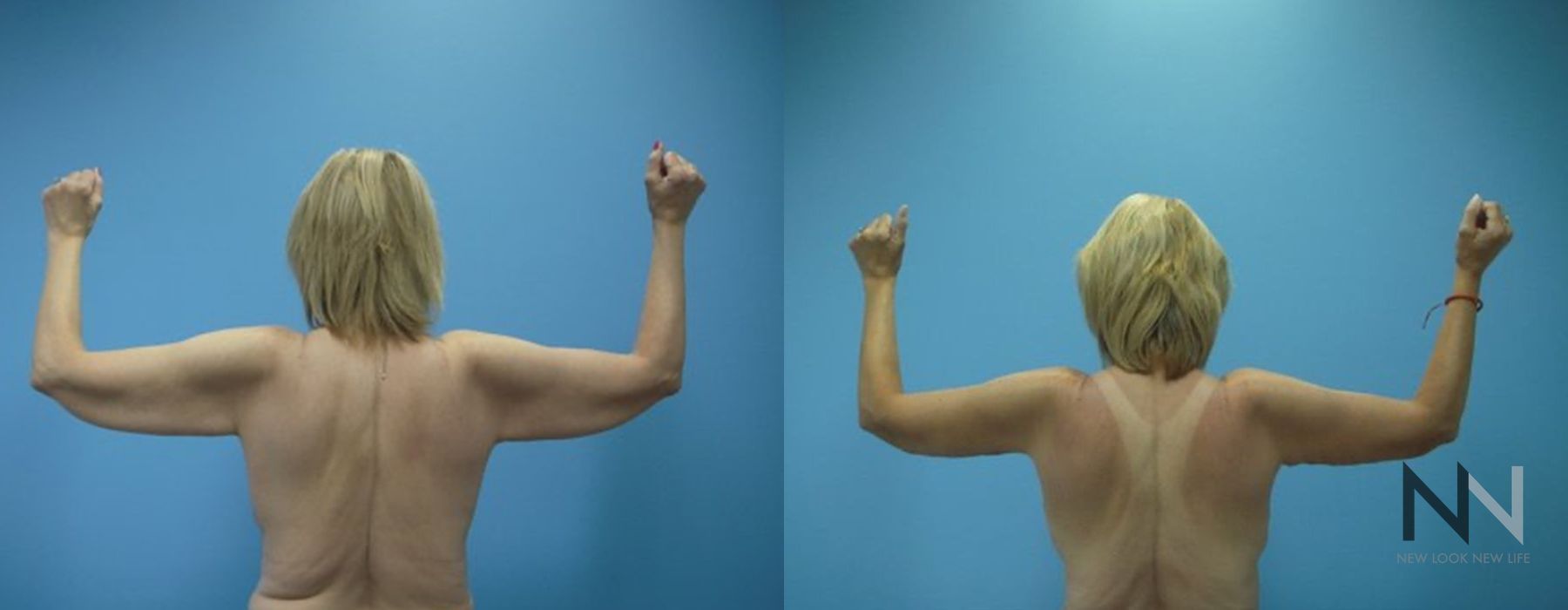 Arm Lift - Case 1968