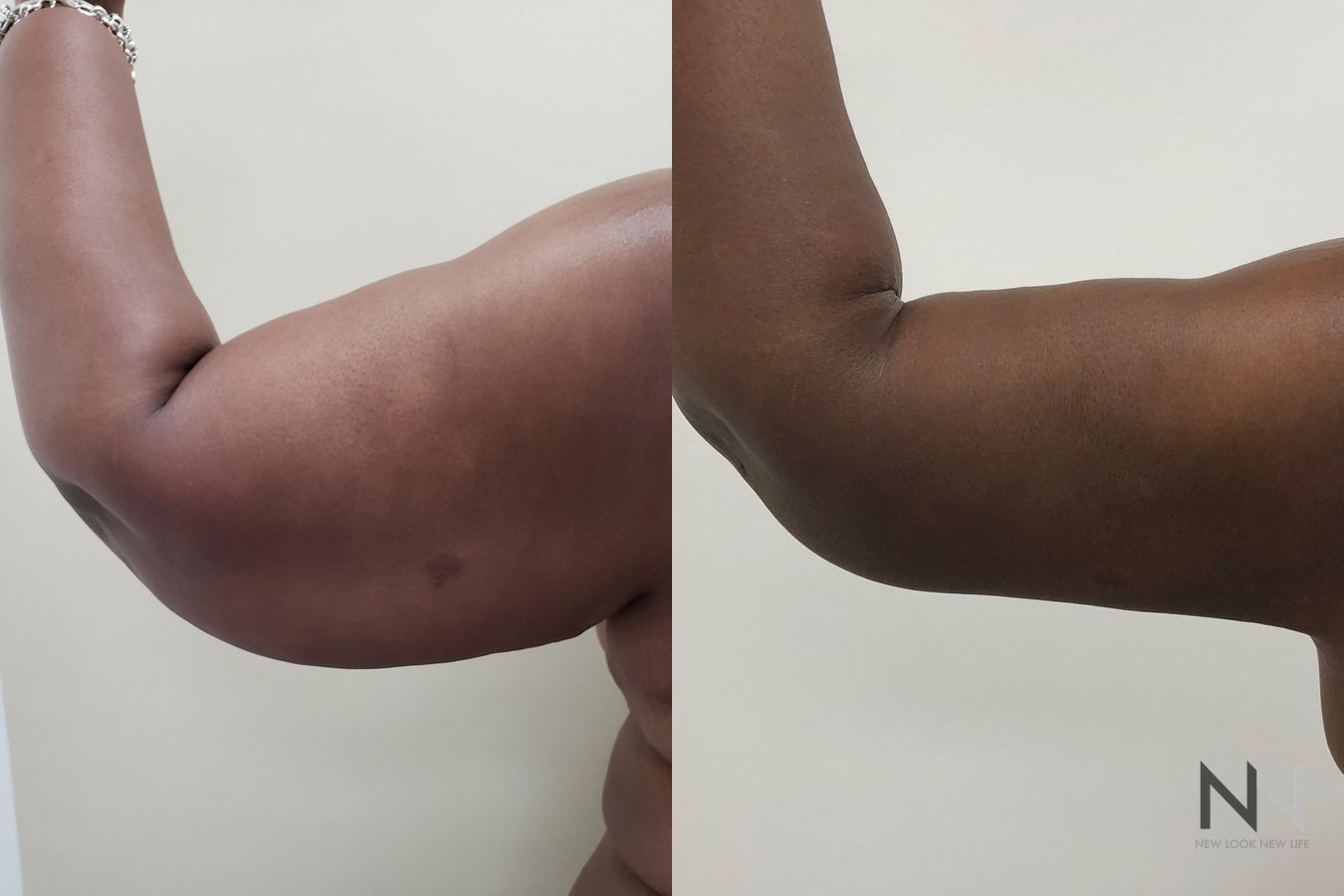 Brachioplasty results for 45-year-old female patient/
