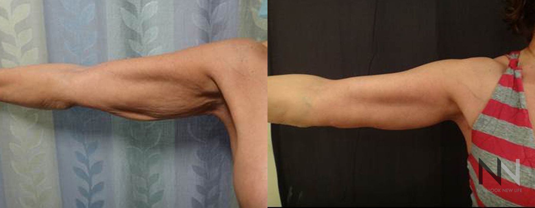 Arm Lift - Thumbnail 2