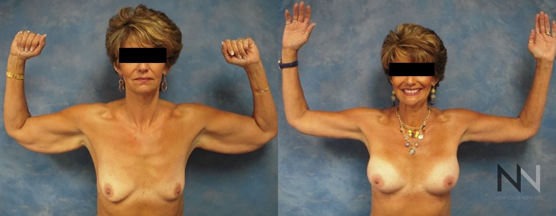 Arm Lift - Thumbnail 2