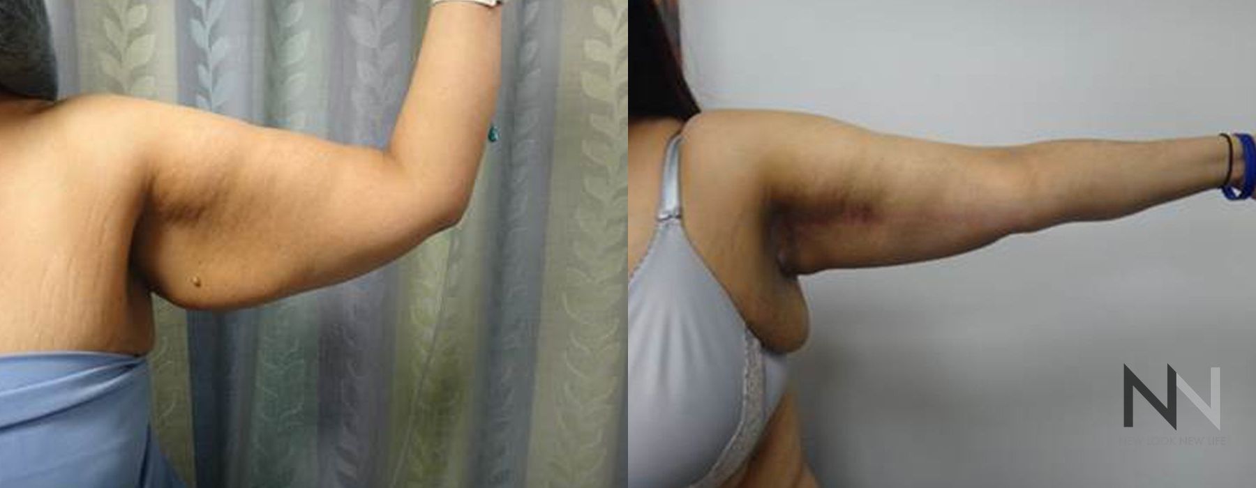 Arm Lift - Case 1965