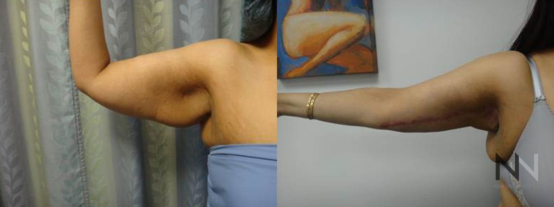 Brachioplasty results with smoother upper arm contour - Angle 2