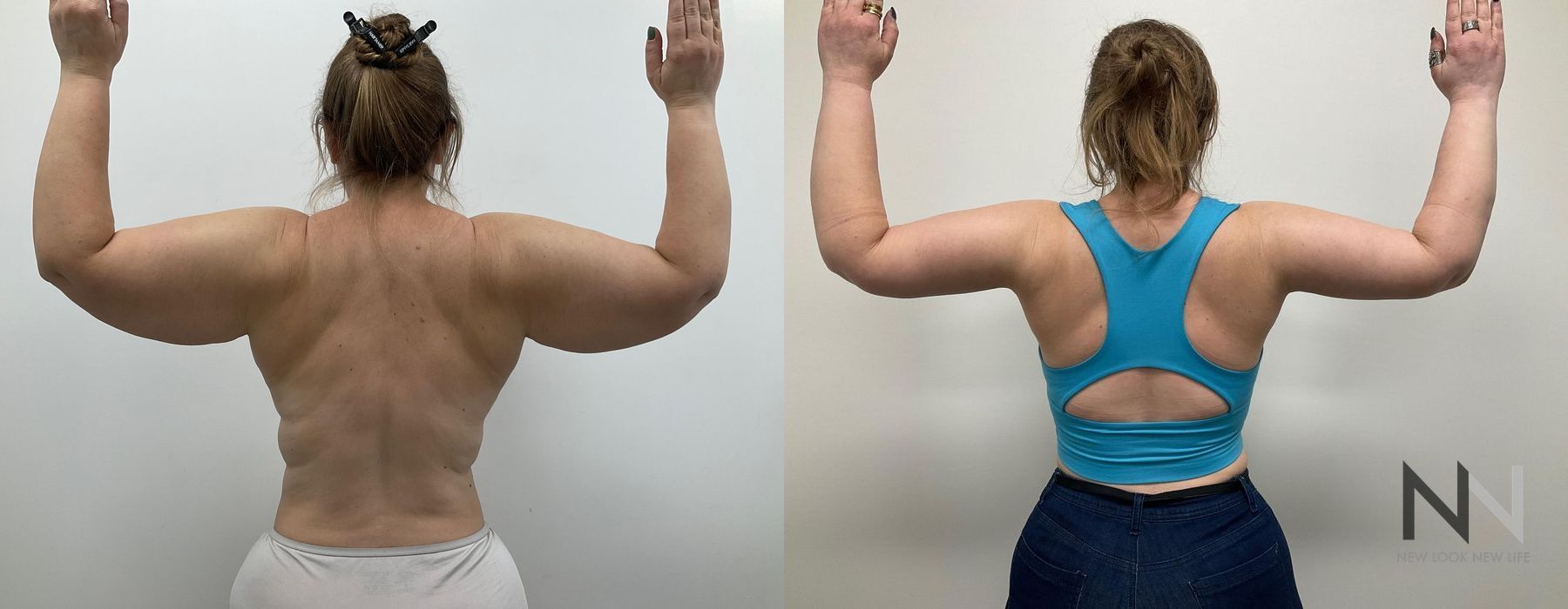 Arm Lift - Case 1779