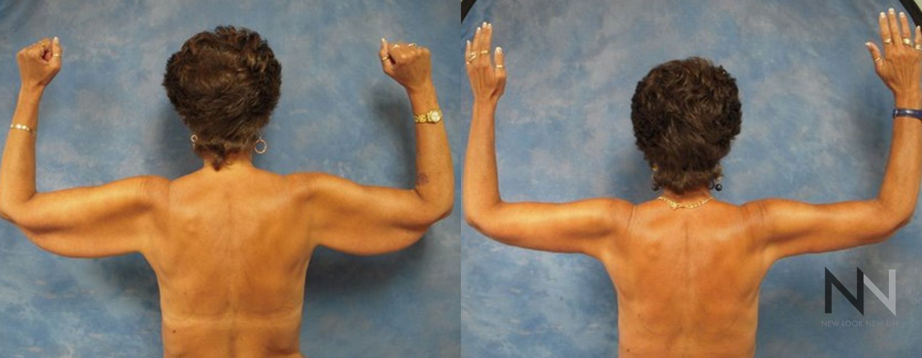 Arm Lift - Case 1964