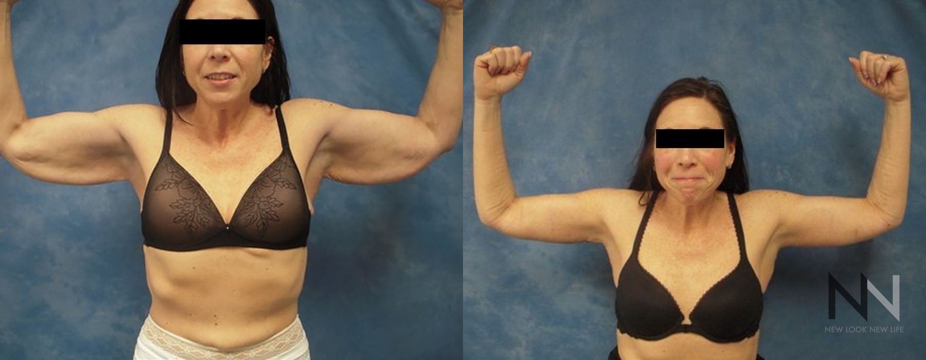 Arm Lift - Case 1966