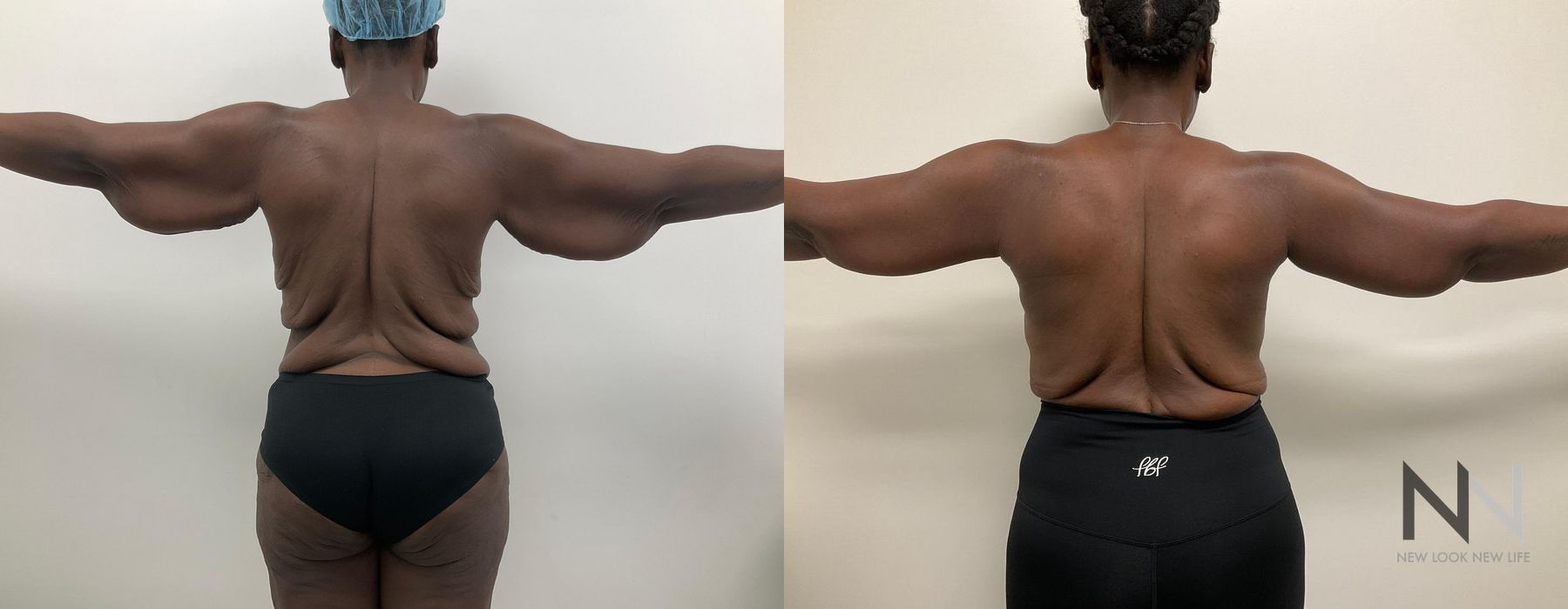 Arm Lift - Thumbnail 2