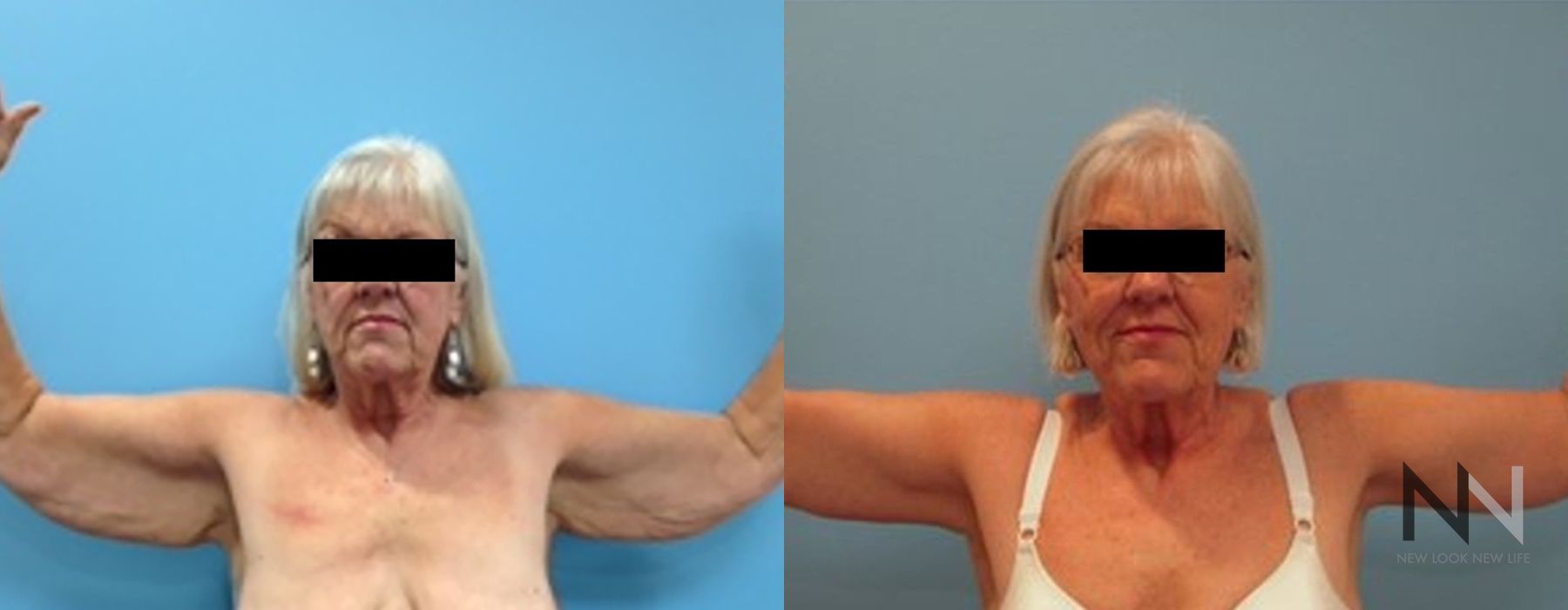 Arm Lift - Case 1788